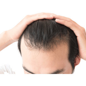 mannelijke kaalheid alopecia androgenetica
